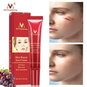 Acne Scar Removal Face Cream Acne Spots Acne Pigmentation Corrector Whitening Cream Anti Scar Stretch Marks Repair Skin Care