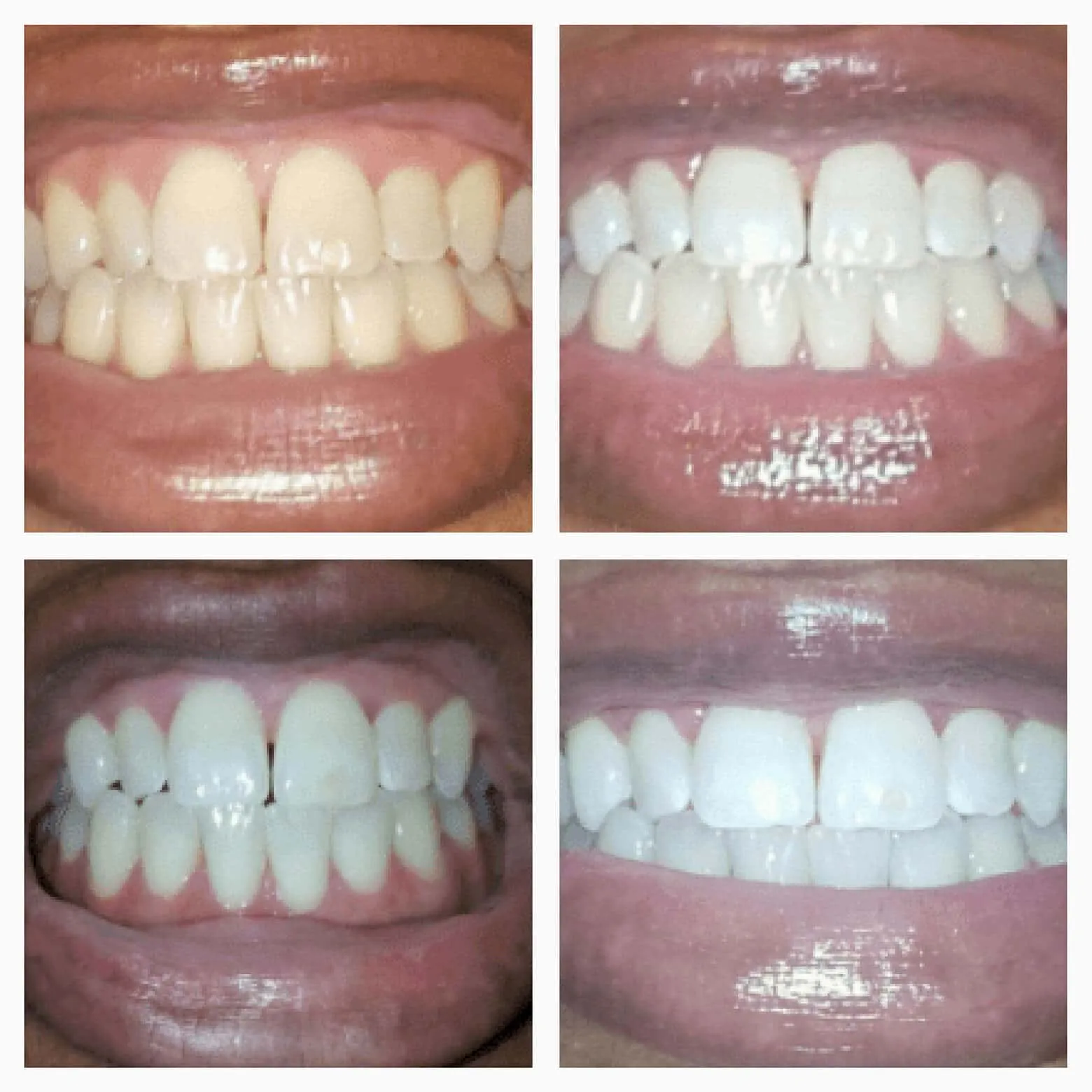 Extra-Strength Teeth Whitening Gold Wand Serum   Dual-Peroxide Formula & Xylitol