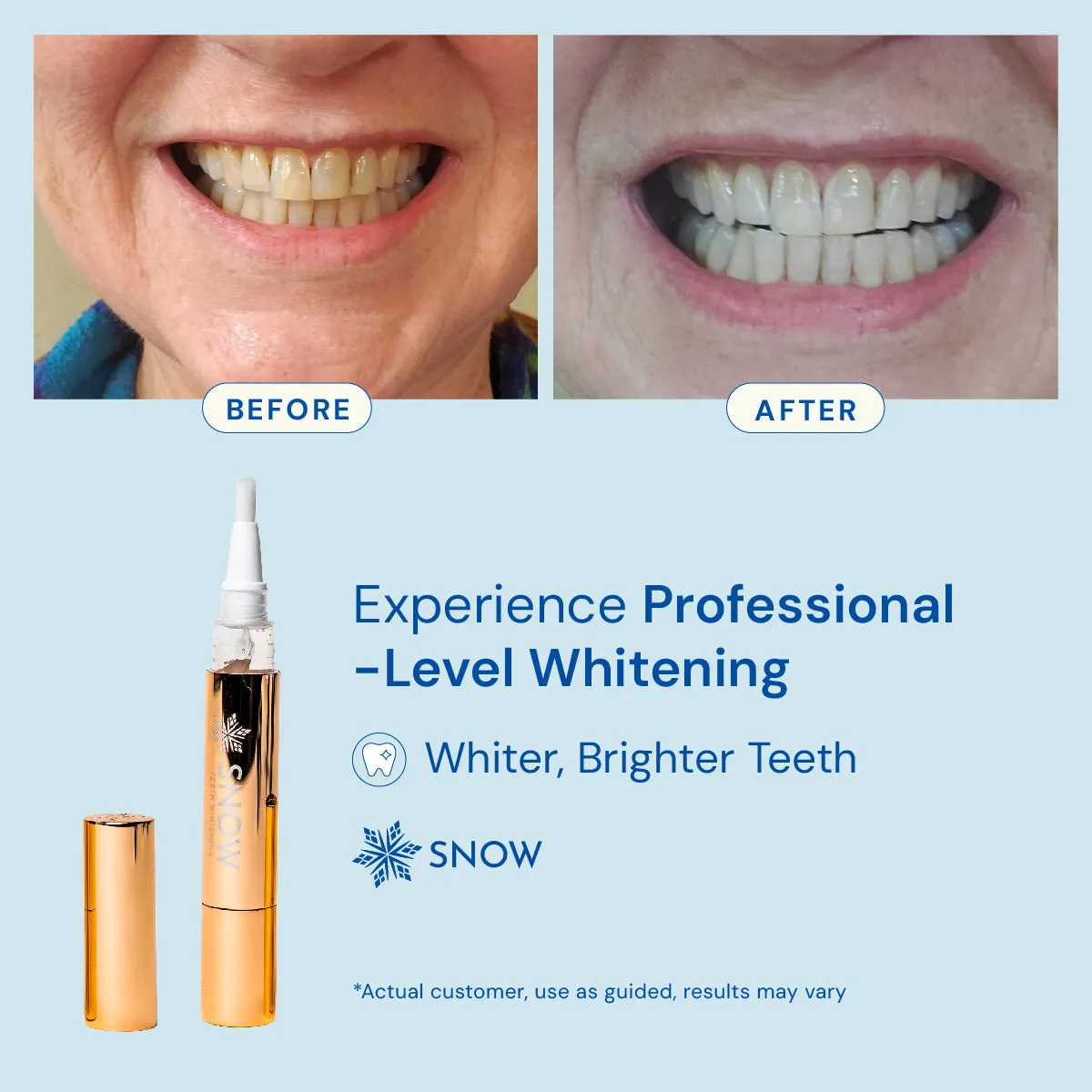 Extra-Strength Teeth Whitening Gold Wand Serum   Dual-Peroxide Formula & Xylitol