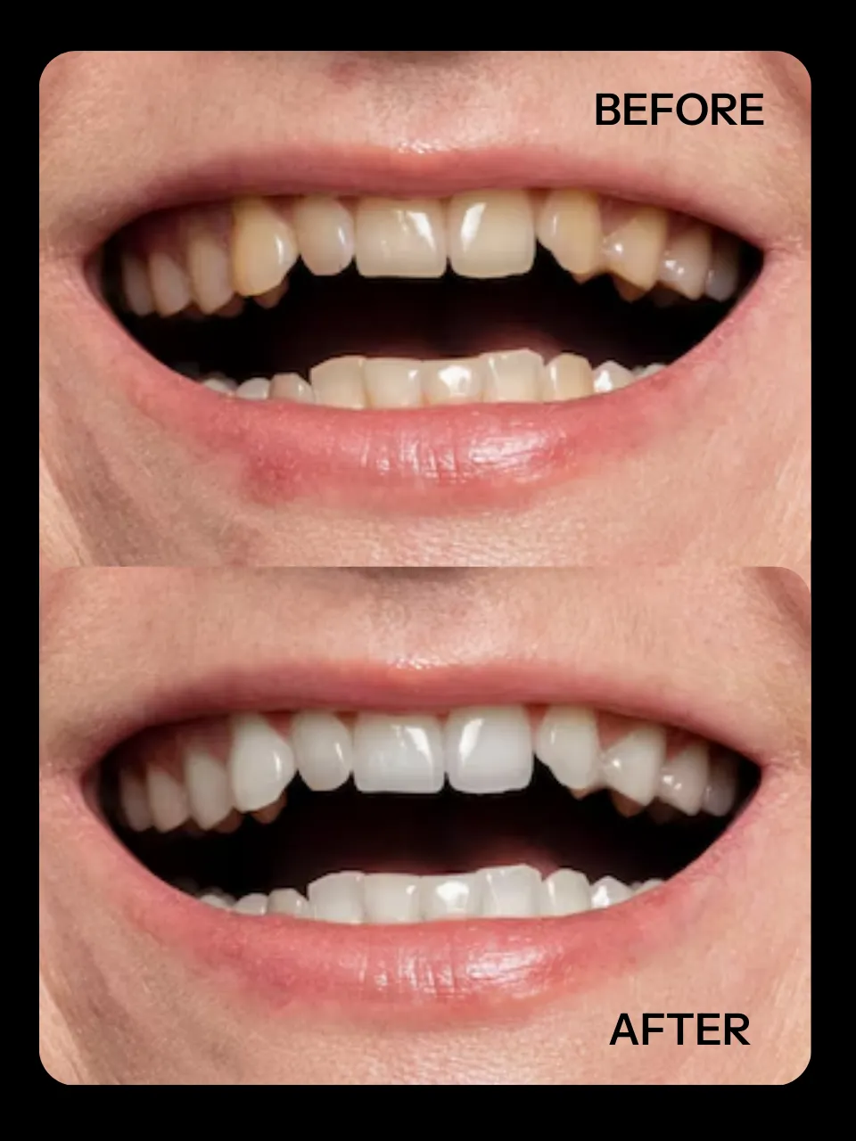 Ivora - Teeth Whitening Serum