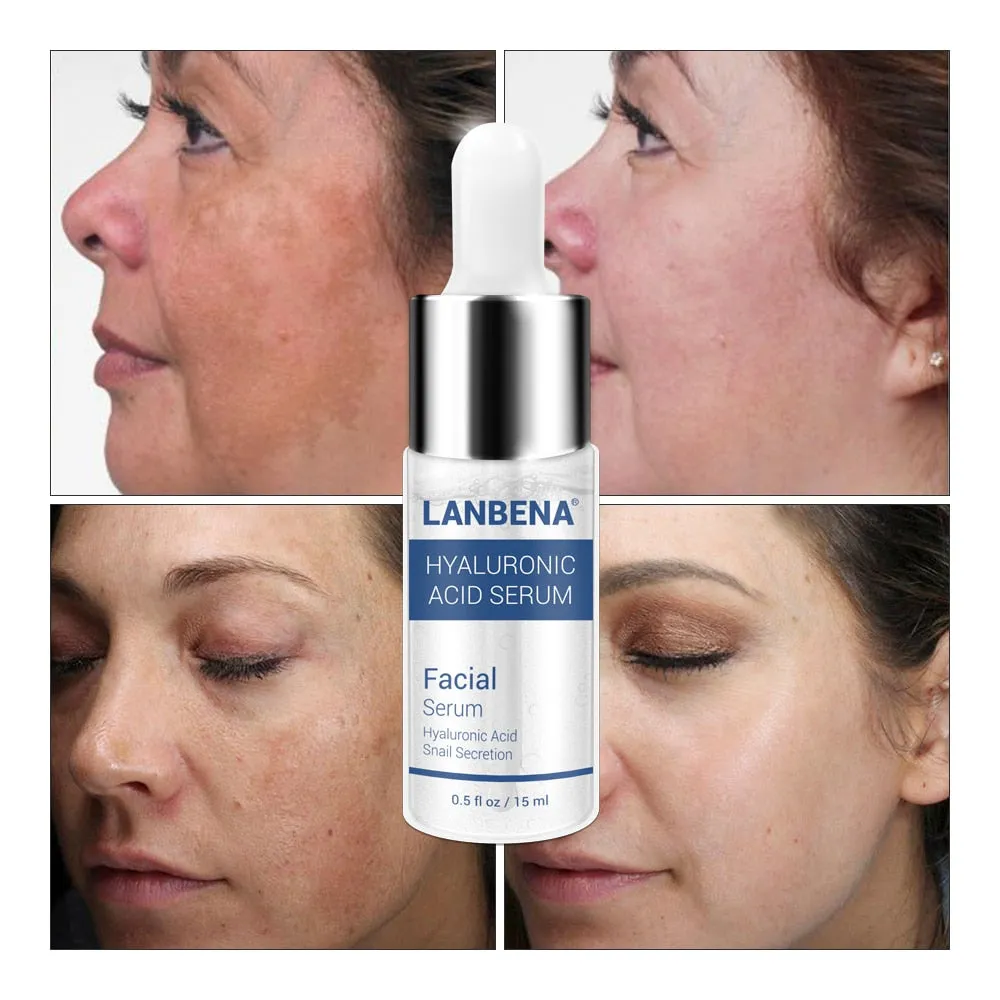 LANBENA Hyaluronic Acid Serum Blackhead Removing Moisturizing Acne Treatment Skin Care Repair Whitening AntiAnging Winkles 15ml