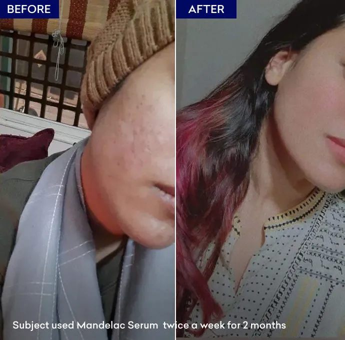 MandelAC Serum